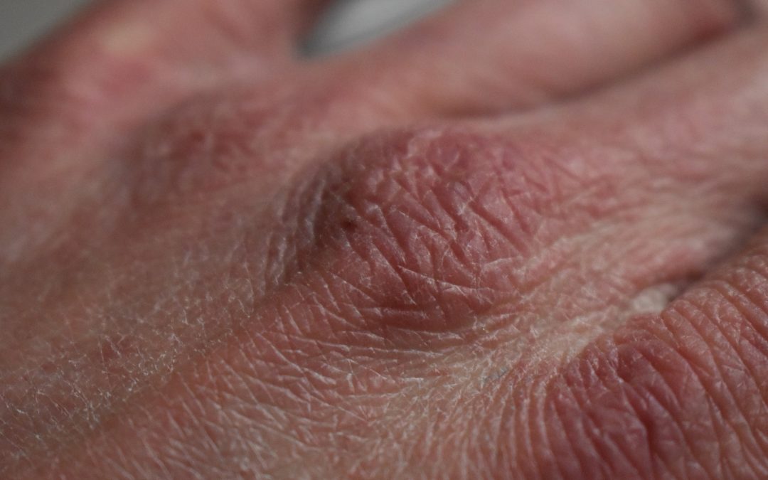 Eczema on hand